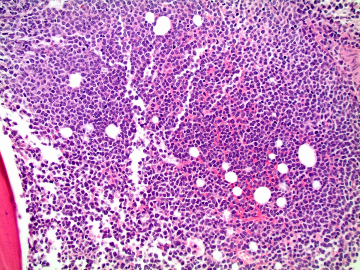 Bone marrow biopsy 200X